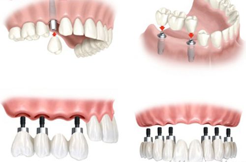 Cấu tạo của răng Implant nha khoa