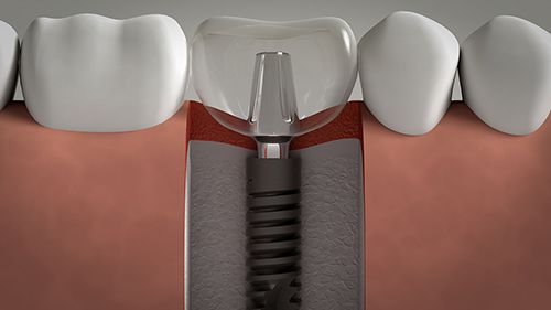 Cấy ghép Implant không phẫu thuật lật vạt