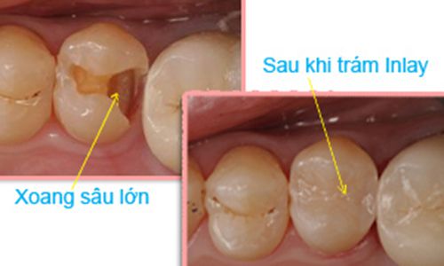 Có nên làm răng sứ Titan cho răng sâu không?