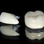 Có nên lựa chọn răng sứ titan không?