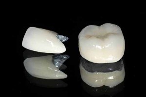 Có nên lựa chọn răng sứ titan không?