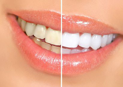 Có nên tẩy trắng răng không?