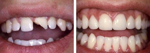 Độ bền của răng sứ cercon duy trì được bao lâu?
