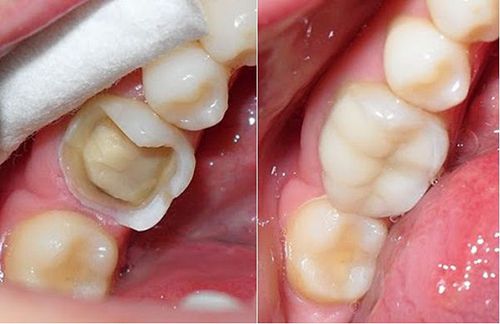 Độ bền của răng sứ cercon duy trì được bao lâu?