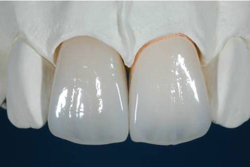 Hiệu quả của phương pháp bọc răng sứ