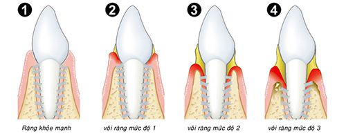 Khi răng bọc sứ bị lung lay phải làm sao?