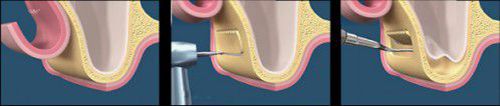 Kỹ thuật nâng xoang thông dụng trong Implant