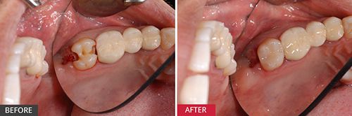 Làm răng hàm bằng răng sứ kim loại có tốt không?