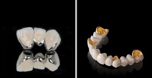 Làm răng hàm bằng răng sứ kim loại có tốt không?