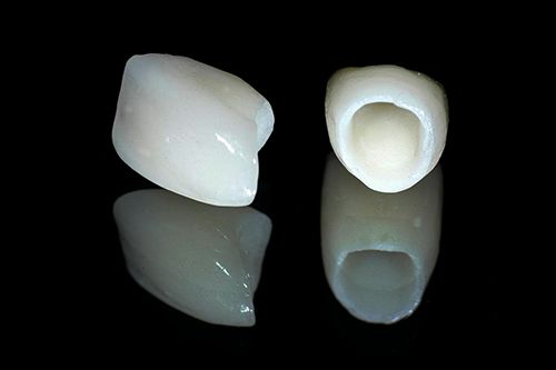  Nên lựa chọn loại răng sứ nào?