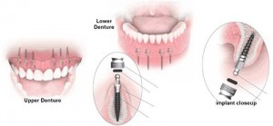 Những trường hợp phải dùng thêm Mini Implant
