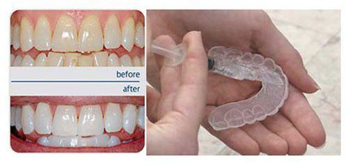 Răng sứ có tẩy trắng được không?