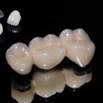 Răng sứ kim loại thường có độ bền bao lâu?
