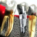Sau khi cấy ghép răng Implant nên ăn những gì?