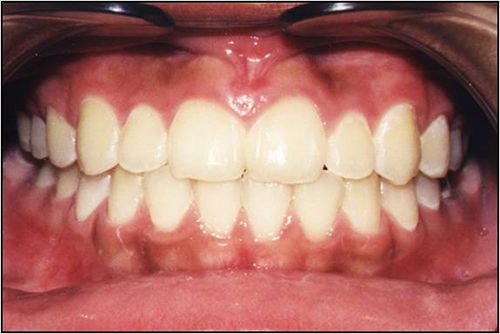  Tại sao xương hàm bị tiêu hủy sau mất răng?