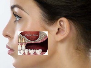 Tại sao xương hàm bị tiêu hủy sau mất răng?