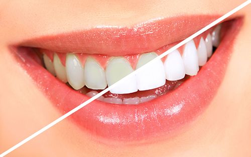 Tẩy trắng răng bằng công nghệ Bleach Bright