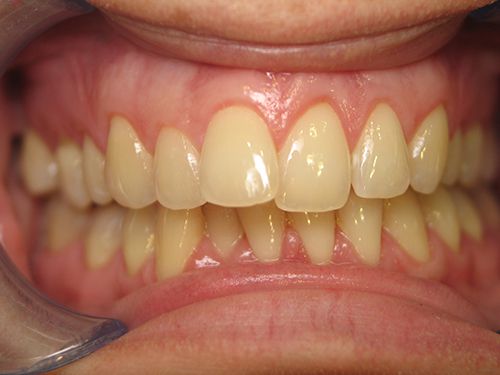Tẩy trắng răng có hại gì không?