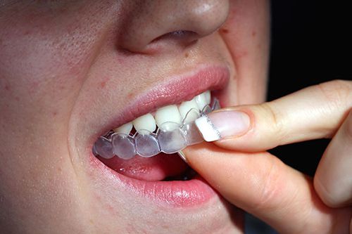 Tẩy trắng răng như thế nào để đẹp và an toàn?