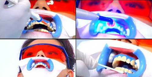 Tẩy trắng răng như thế nào để đẹp và an toàn?