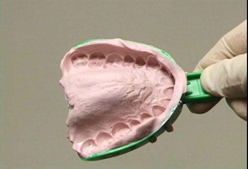 Tẩy trắng răng tại nhà hiệu quả với máng tẩy