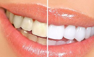 Thời gian tẩy trắng răng mất bao lâu?