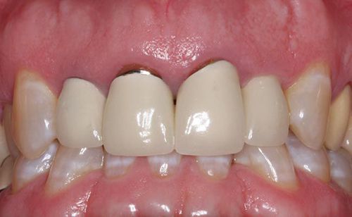 Trồng răng sứ vĩnh viễn giá bao nhiêu tiền?