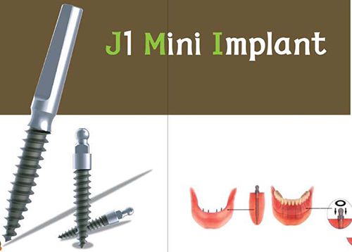 Ưu điểm của Mini Implant