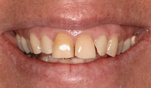 Những ưu điểm nổi bật của răng sứ thẩm mỹ