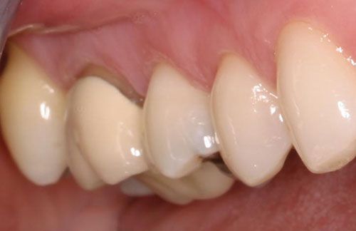 Ưu và nhược điểm của răng sứ Cercon
