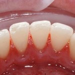 Cạo vôi răng có gây đau nhức răng miệng không?