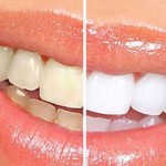 Cạo vôi răng có làm trắng răng không?
