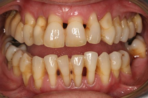 Cạo vôi răng có tác dụng gì?