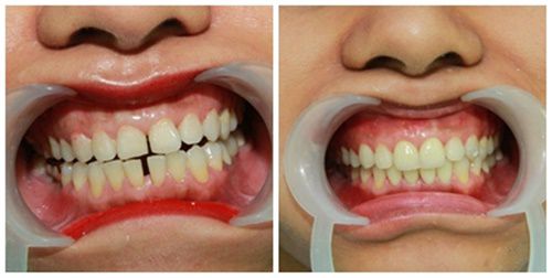 Có nên trám răng bằng Composite hay không?