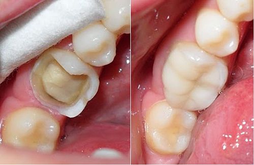 Có nên trám răng bằng Composite hay không?