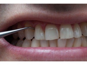 Có nên lấy cao răng thường xuyên không?