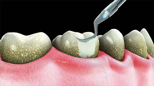 Lợi ích của việc lấy cao răng định kỳ