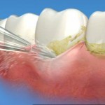 Sự khác nhau giữa tẩy trắng răng và lấy cao răng