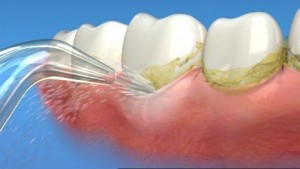 Sự khác nhau giữa tẩy trắng răng và lấy cao răng