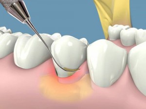Tác hại của cao răng mà bạn chưa biết