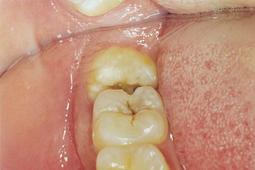 Tác hại của cao răng mà bạn chưa biết