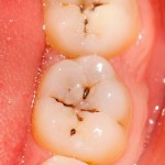 Trám răng sâu hiệu quả nhất giá bao nhiêu tiền?