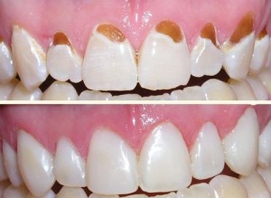 Trám răng tồn tại được bao lâu?
